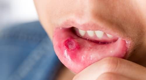 Comment traiter les ulcères de la bouche ou des aphtes?