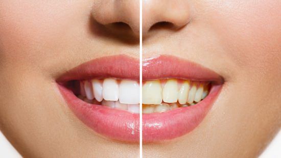 Comment utiliser le peroxyde d'hydrogène pour blanchir les dents?