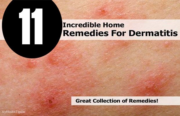 Remèdes maison incroyables pour la dermatite