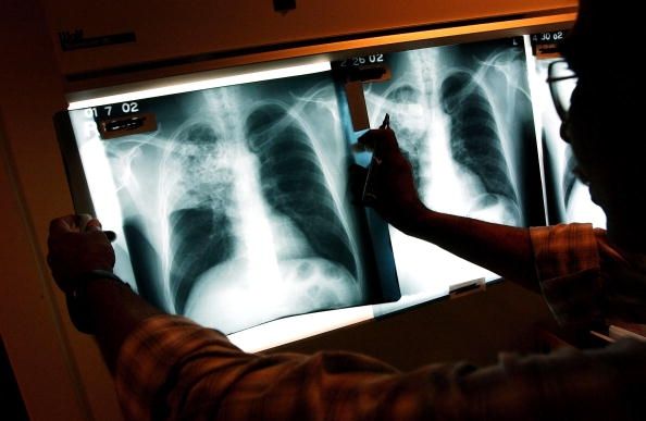 Poitrine de rayons d'une personne atteinte de tuberculose. Une femme est venue aux États-Unis avec la tuberculose résistante aux médicaments. Poitrine de rayons d'une personne atteinte de tuberculose. Une femme est venue aux États-Unis avec la tuberculose résistante aux médicaments.