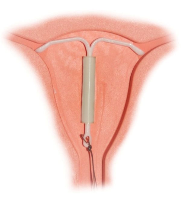 Un DIU peut être inséré à la sécurité à la conclusion d'une césarienne plutôt que d'avoir à attendre quelques semaines. Un DIU peut être inséré à la sécurité à la conclusion d'une césarienne plutôt que d'avoir à attendre quelques semaines.