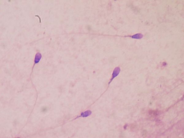 Sperme humain teinté pour les tests de la qualité du sperme en laboratoire clinique.