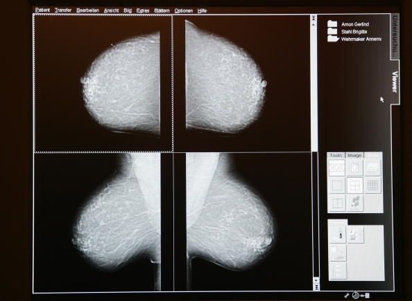 Beaucoup de femmes qui ont le cancer du sein envisager de supprimer leur autre sein en raison de s'inquiéter. Beaucoup de femmes qui ont le cancer du sein envisager de supprimer leur autre sein en raison de s'inquiéter.
