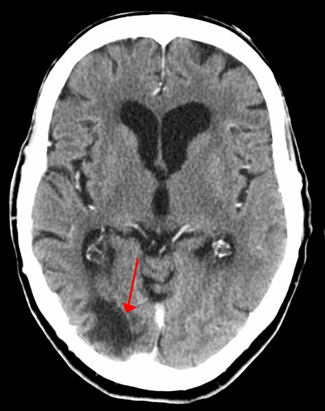 Un scanner montrant les effets d'un accident vasculaire cérébral. La zone sombre sous le pointeur est la zone où la course a eu lieu.