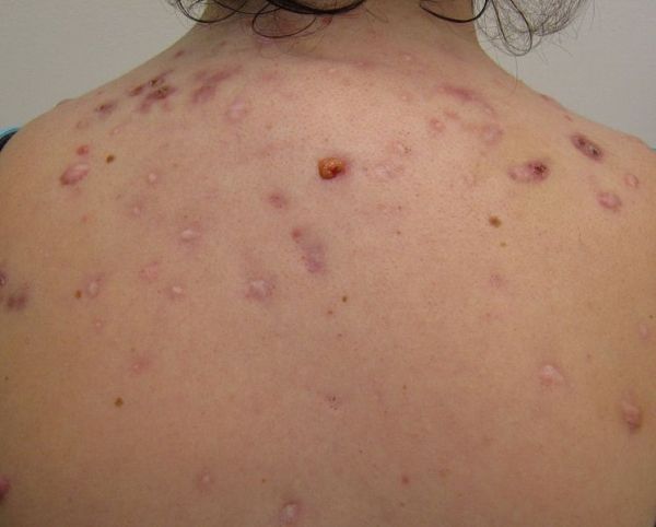L'acné kystique sur le dos.