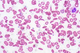 Dans la drépanocytose, certaines cellules sanguines peuvent se détourner de la forme ronde normale dans les cellules falciformes-rigides.
