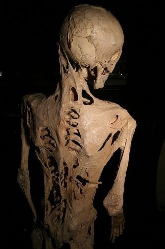 Le squelette d'une personne qui a souffert de fibrodysplasie ossifiante progressive, une maladie rare qui provoque des tissus mous à se tourner vers l'os.