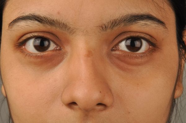 Plusieurs facteurs peuvent causer des cernes sous les yeux