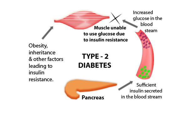 Les effets à court terme du diabète de type 2