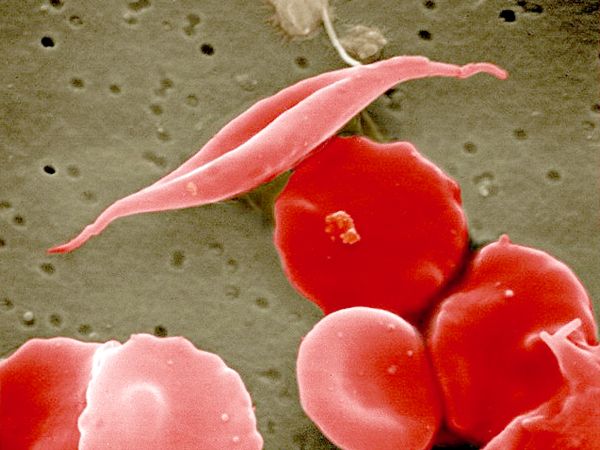 Anormalement globules déformés est la caractéristique la plus marquante de la drépanocytose.