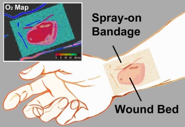 Innovative & # bandage 034-SMART & # 034- est une préparation de plâtre liquide qui est infusé avec des indicateurs phosphorescente d'oxygénation.