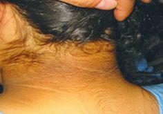 Meilleurs remèdes maison pour se débarrasser de l'obscurité Neck