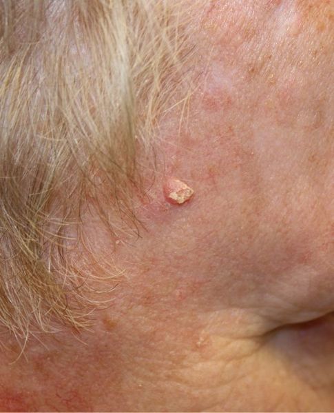 Le carcinome épidermoïde, un type de cancer de la peau