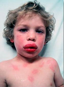 Les enfants exposés à la protéine d'arachide que les nourrissons sont 20% plus susceptibles de développer une allergie à l'arachide