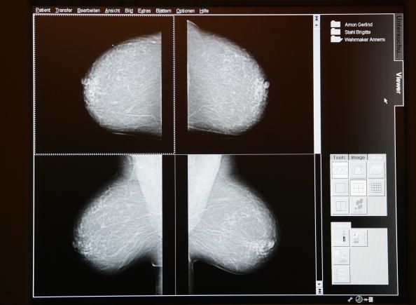 Une femme qui est diagnostiqué avec carcinome canalaire in situ, l'étage le plus bas de cancer du sein, présente un faible risque de mourir du cancer du sein