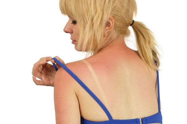 Traitement Sunburn Comment traiter la peau des coups de soleil
