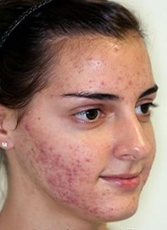 L'acné peut être une circonstance embarrassante pour les adolescents