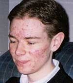 L'acné de l'adolescence est pas une chose amusante pour un adolescent de passer par