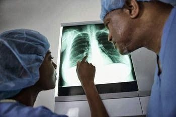 L'état de Lung cicatrices et des remèdes naturels pour la guérison
