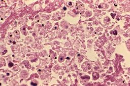 Une vue microscopique du tissu pulmonaire infecté par la bactérie Legionella.