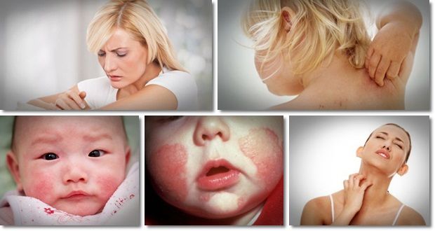 Remèdes pour l'eczéma