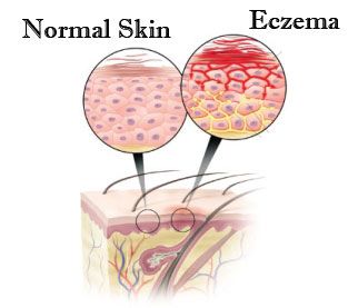 Top 12 remèdes naturels pour l'eczéma