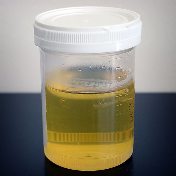 échantillon d'urine