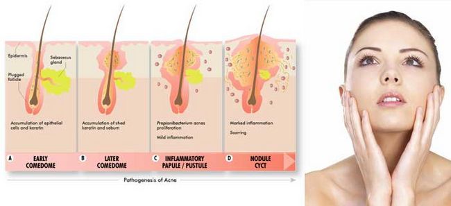 Qu'est-ce que l'acné et les causes d'acné