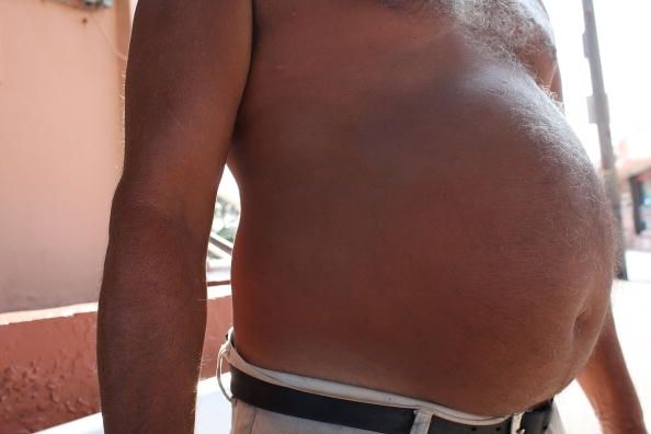 Avoir l'obésité abdominale peut être une partie du syndrome métabolique, qui affecte environ une personne sur trois Américains. Avoir l'obésité abdominale peut être une partie du syndrome métabolique, qui affecte environ une personne sur trois Américains.