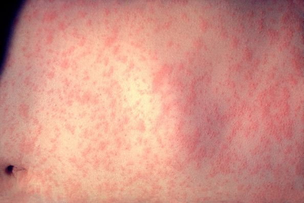 Épidémies de rougeole se répandre dans États-Unis