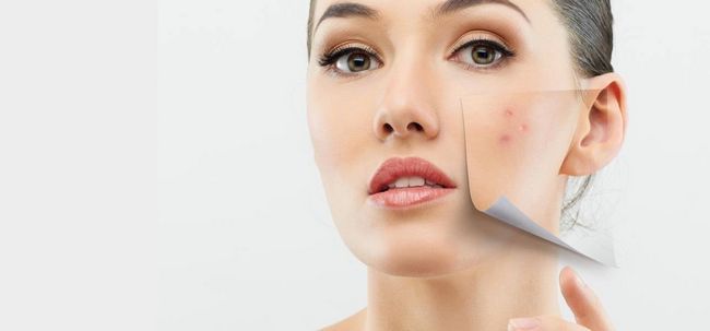 10 remèdes simples pour traiter l'acné de la peau sèche