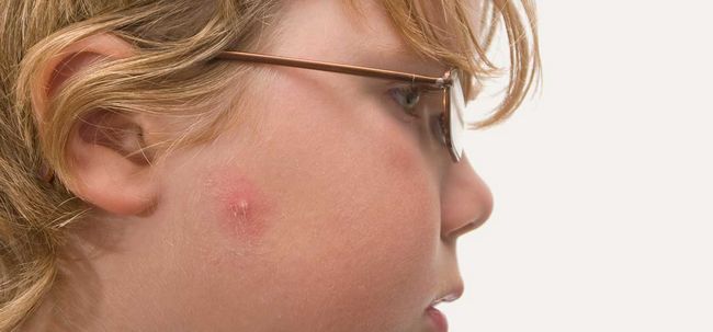 11 différents types d'acné et comment les identifier?