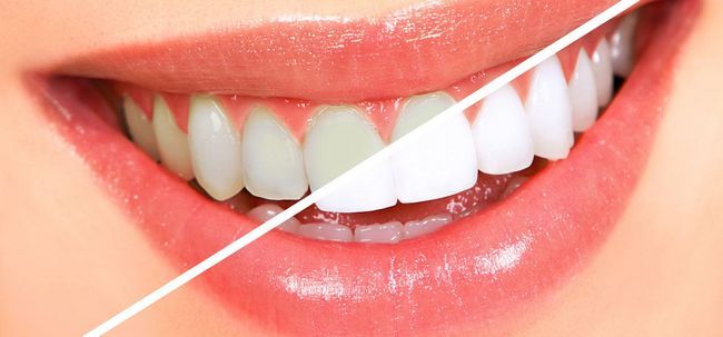 13 façons simples pour obtenir White Teeth Nuit