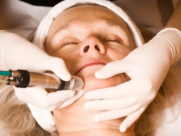 Épilation du visage par électrolyse