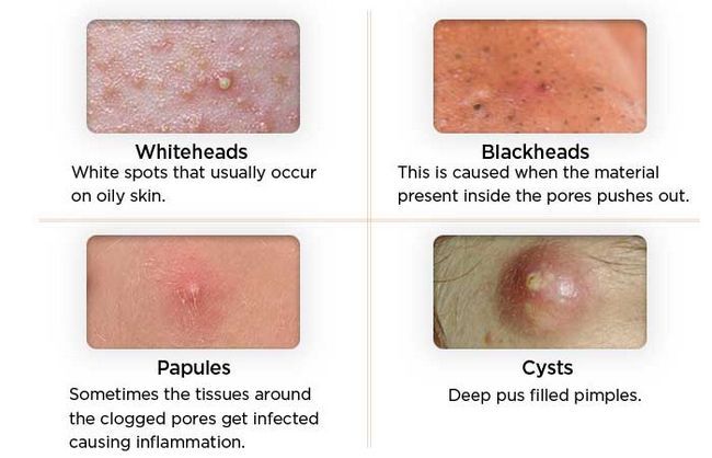 Types de boutons