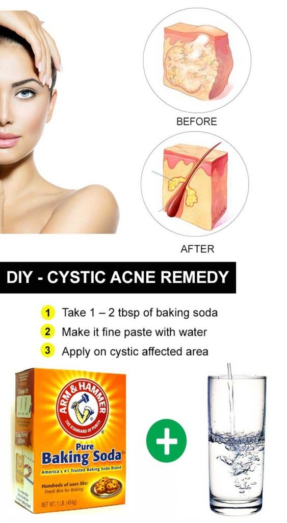 cystics-acné