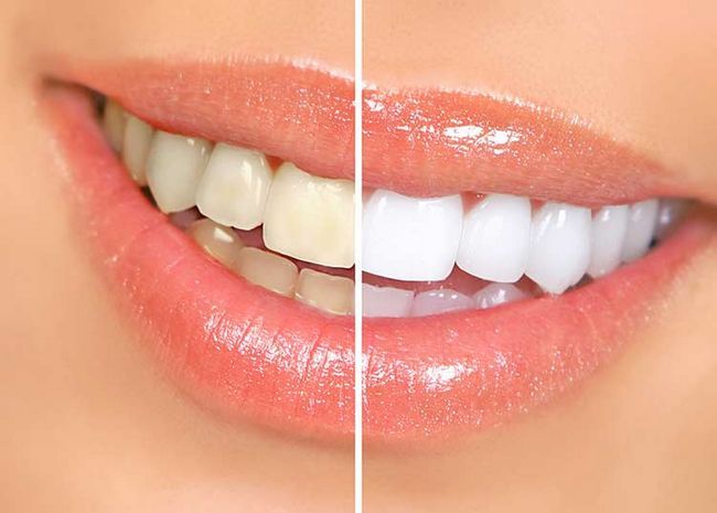 16 façons naturelles de bricolage pour blanchir les dents
