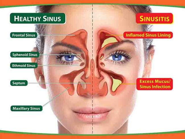 Infection des sinus