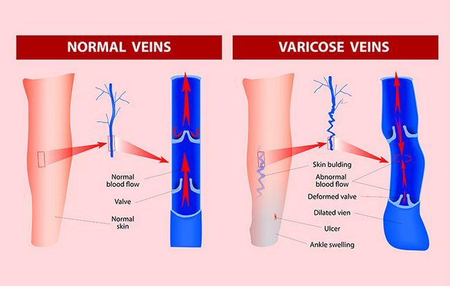 Causes varices