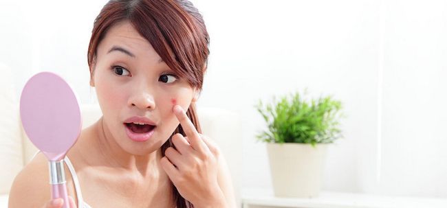 20 conseils efficaces pour soigner et prévenir l'acné chez les adolescentes