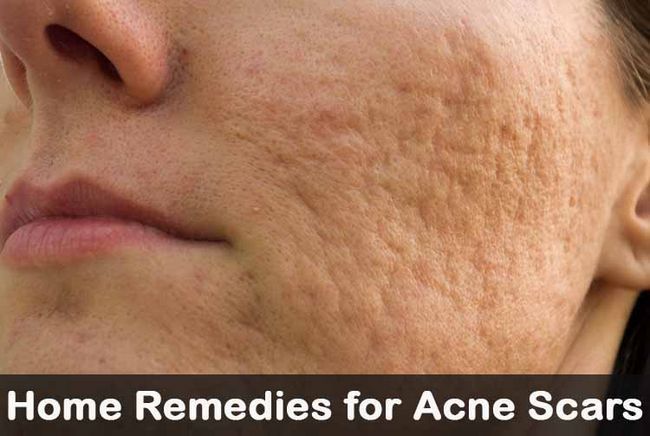 25 remèdes maison de bricolage pour les cicatrices d'acné