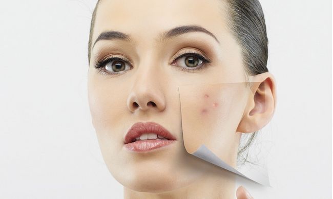 37 remèdes maison bricolage pour l'acné