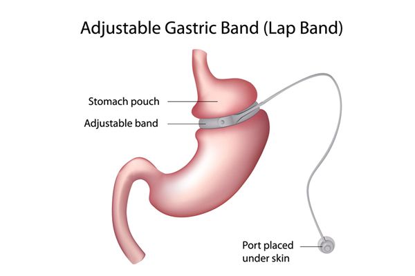 la chirurgie gastrique de bande