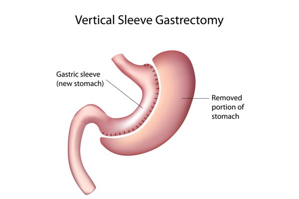 manchon gastreactomy