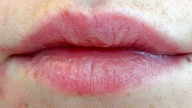5 meilleurs remèdes maison pour les lèvres sèches et gercées