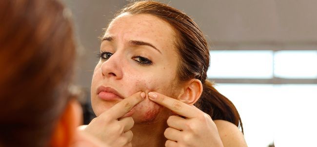 5 Traitements acné simple mais très efficace