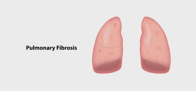 8 remèdes efficaces maison pour traiter la fibrose pulmonaire