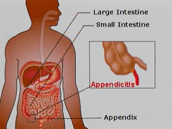 appendicite