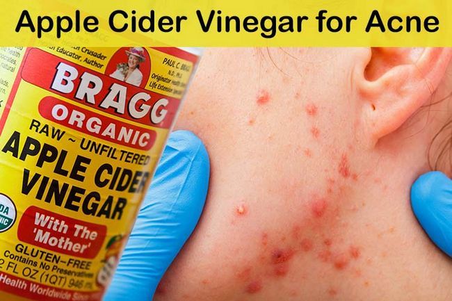 Apple Cider Vinegar pour l'acné 1