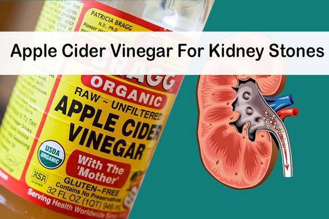 Apple Cider Vinegar pour des calculs rénaux